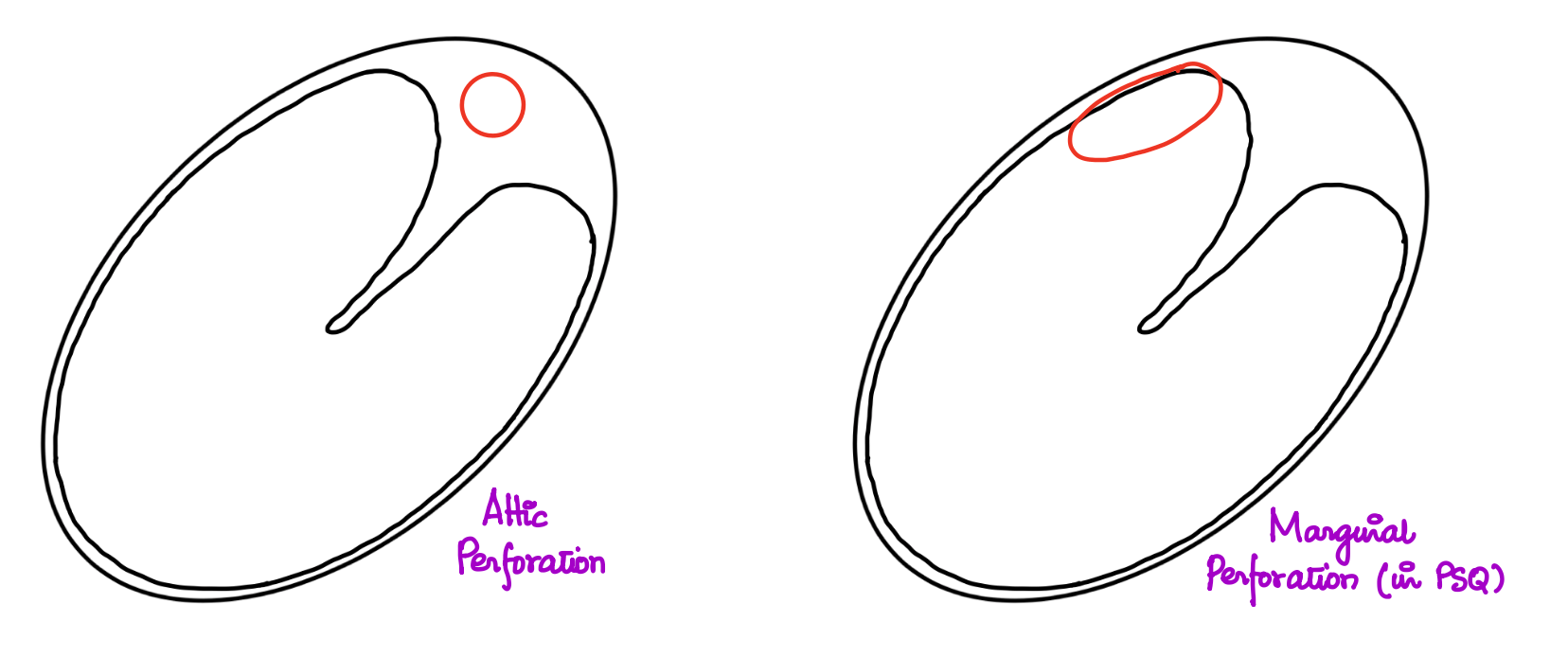 Attic Perforation and Marginal Perforation