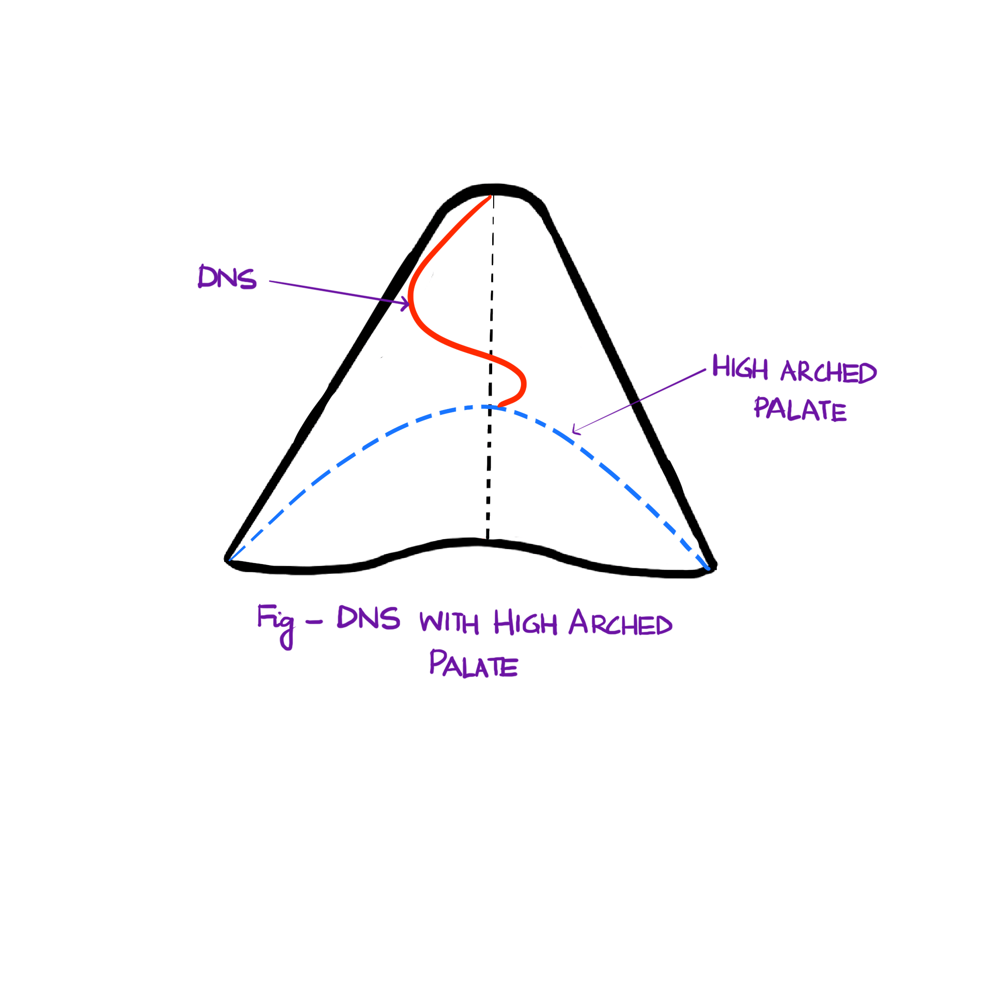 Deviated Nasal Septum in High arched palate