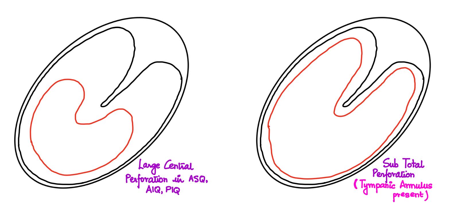 Large Central Perforation and Subtotal Perforation