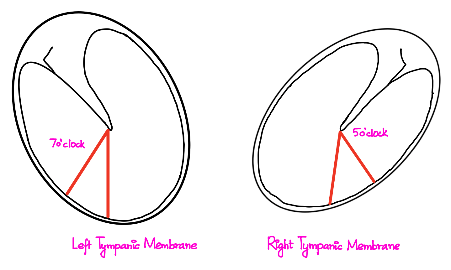 Right and Left Tympanic Membrane