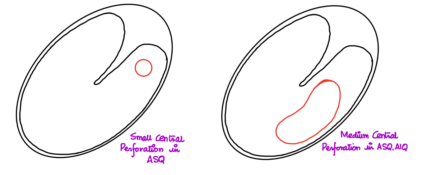 Small and Medium Central Perforation