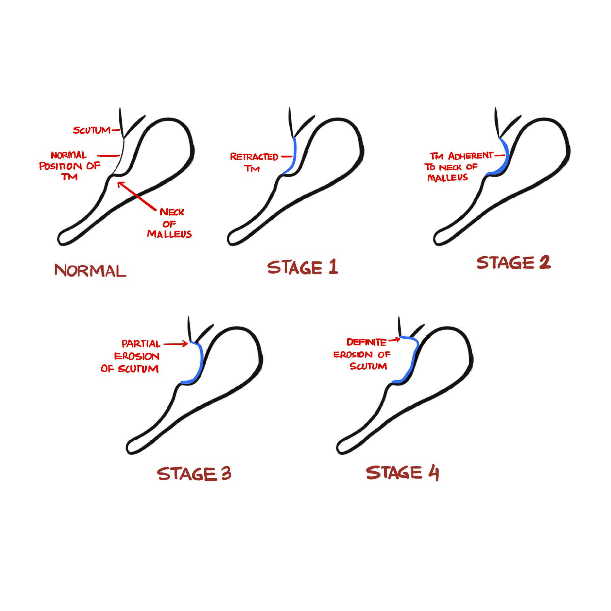 Tos Classification of Pars Flaccida Retraction