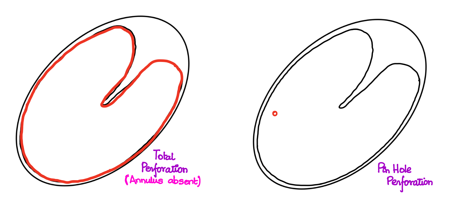 Total Perforation and Pinhole Perforation