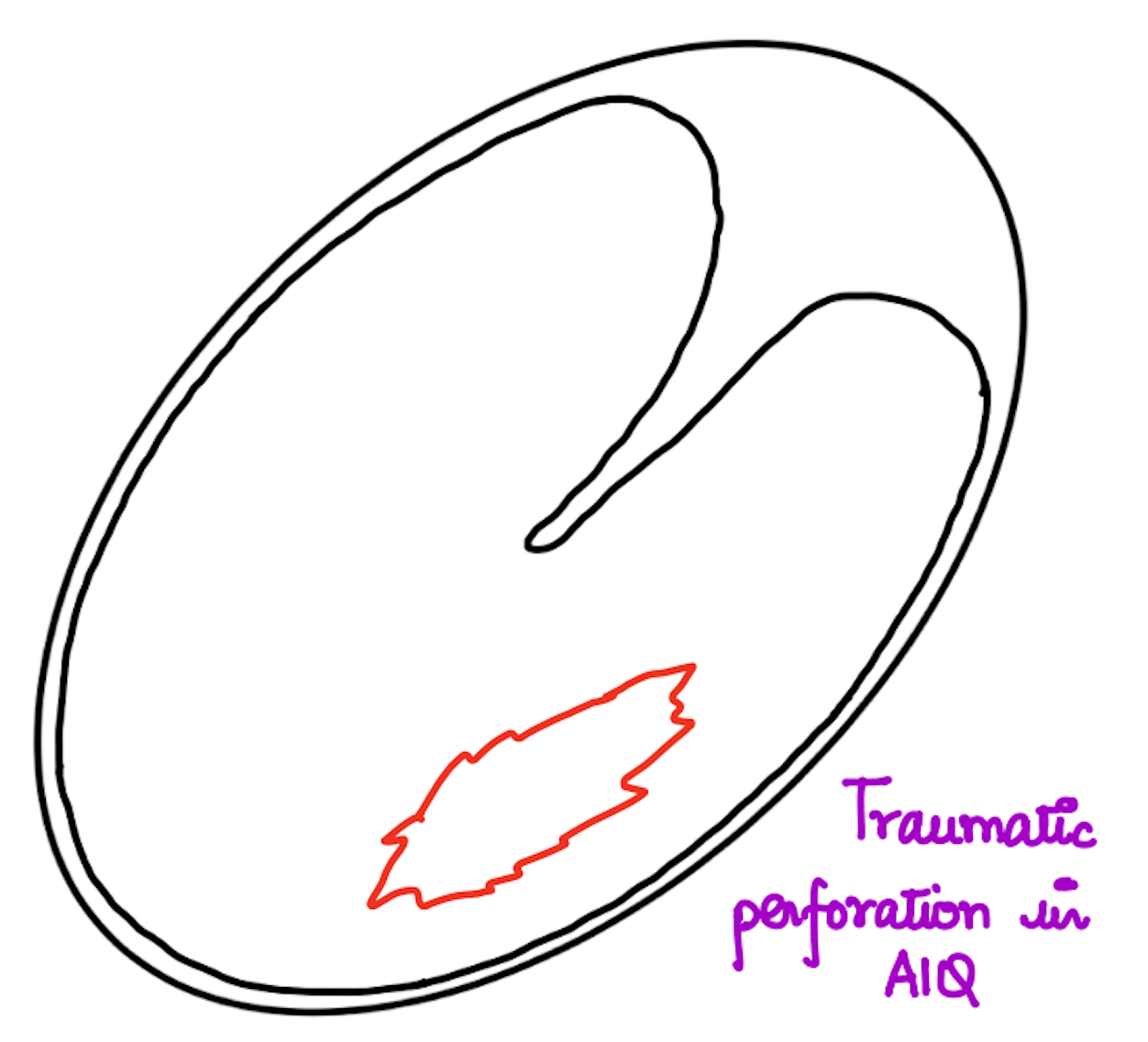 Traumatic Perforation