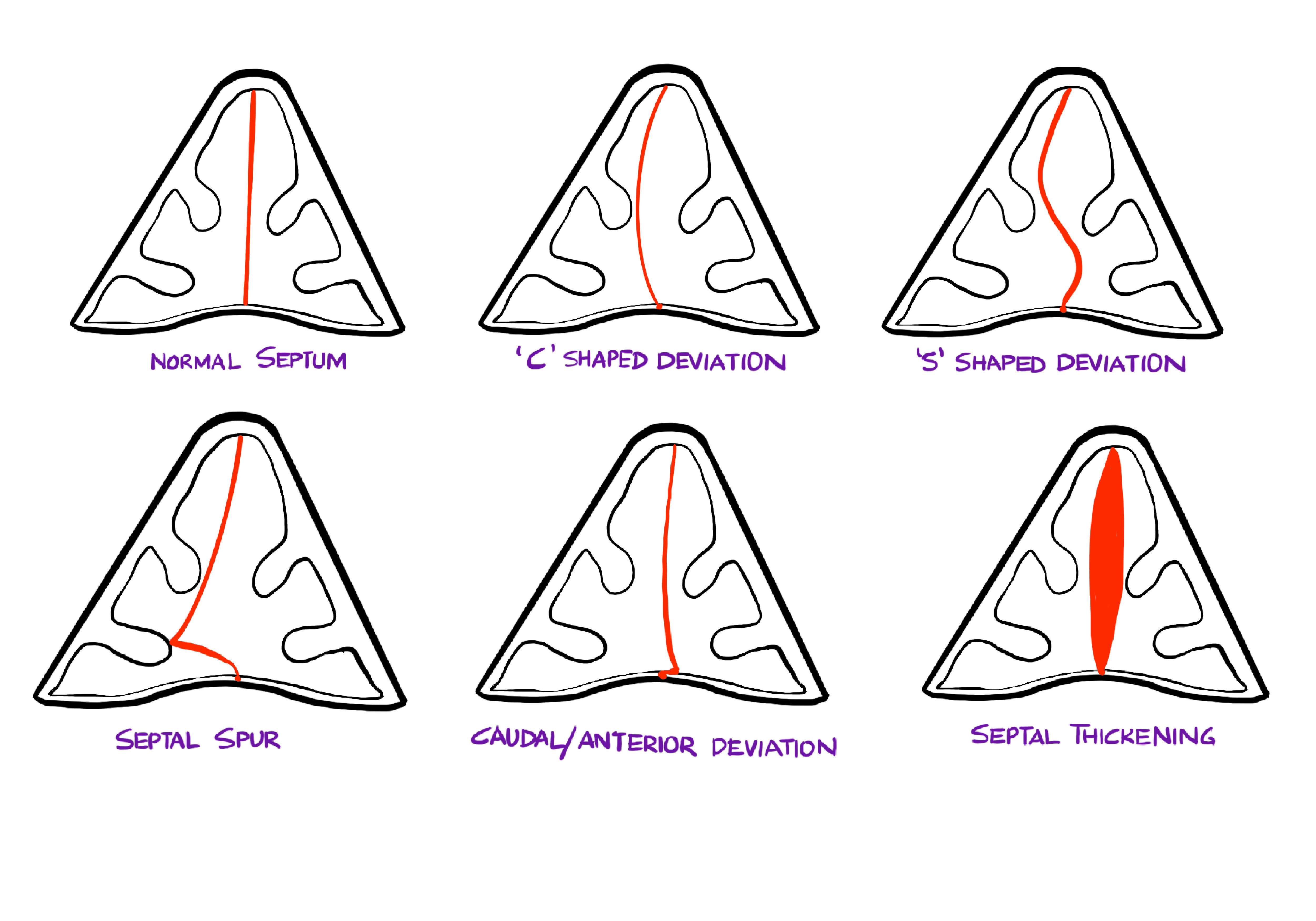 Morphological classification of Types of Deviated Nasal Septum